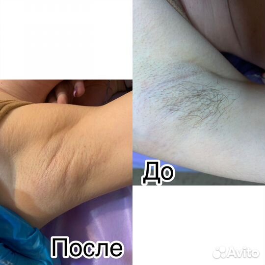 Шугаринг