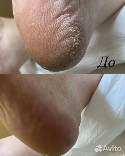 Смарт педикюр