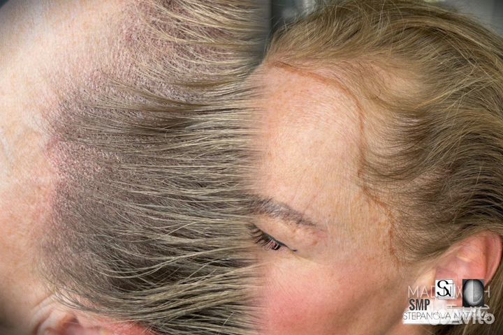 Трихопигментация SMP