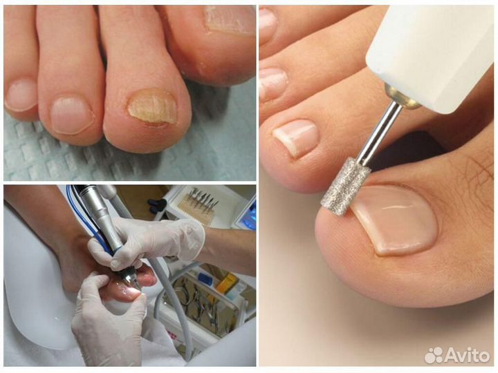 Подологический педикюр