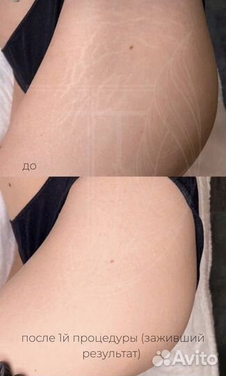 Камуфляж шрамов, растяжек, рубцов