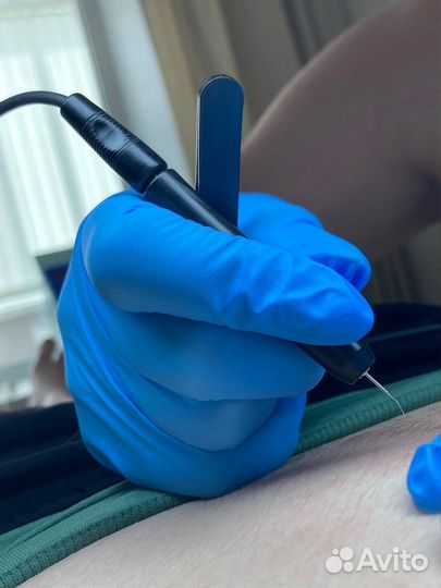 Электроэпиляция