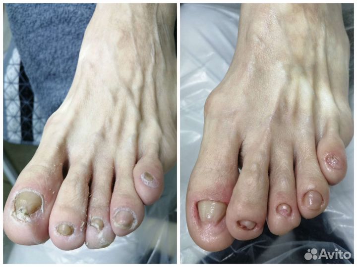 Снятие гель-лака с ногтей на ногах