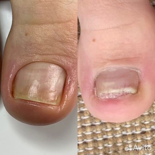 Медицинский педикюр