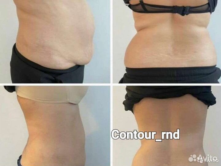 Антицеллюлитный массаж, лимфодренаж, коррекция