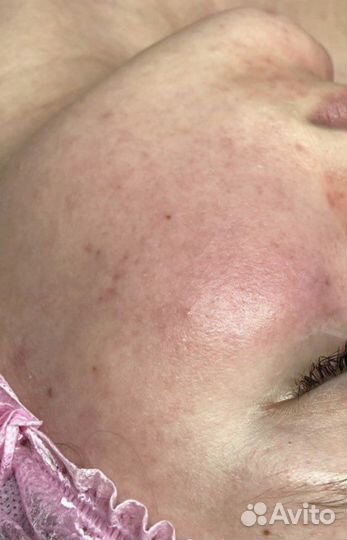 Уход / Инъекции / Лечение лица или волос