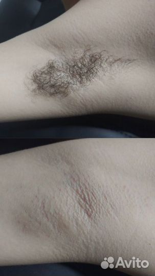 Шугаринг депиляция удаление волос воском