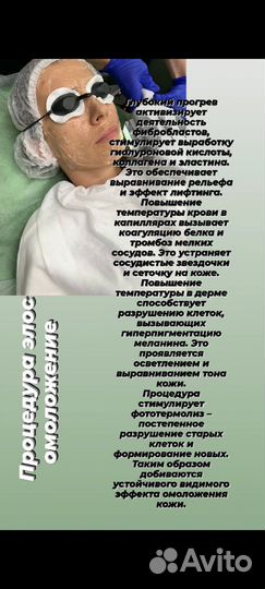 Лазерная эпиляция