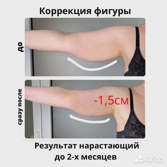 Подтяжка кожи на теле и руках