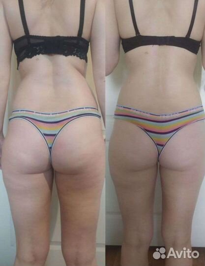 Аппаратный массаж, коррекция фигуры, похудение