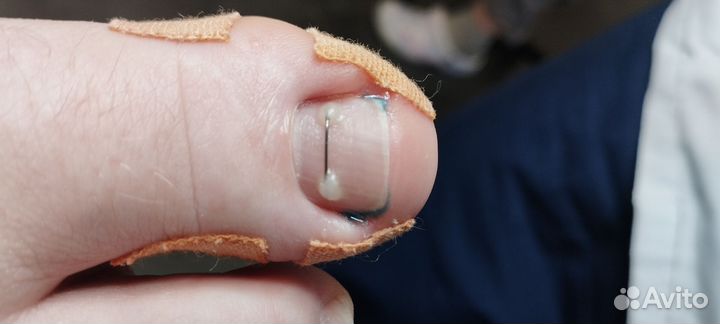 Установка титановой нити