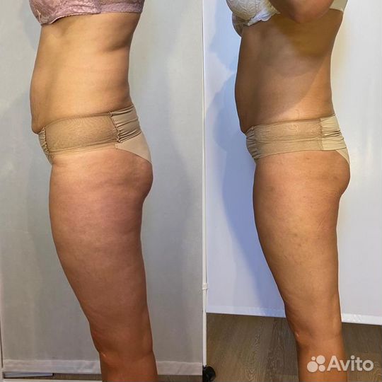 Аппаратный массаж (lpg,vela shape,субдермальный)