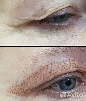 Мультиплазменное омоложение кожи