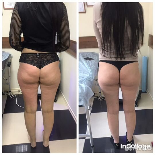 Массаж антицеллюлитный/lpg/кавитация/RF лифтинг