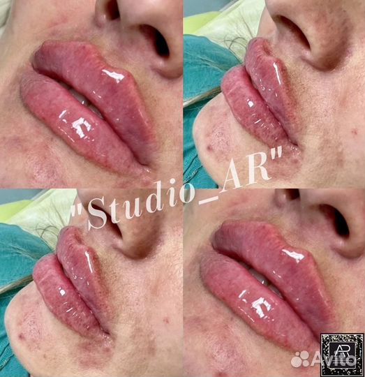 Увеличение губ. Обучение