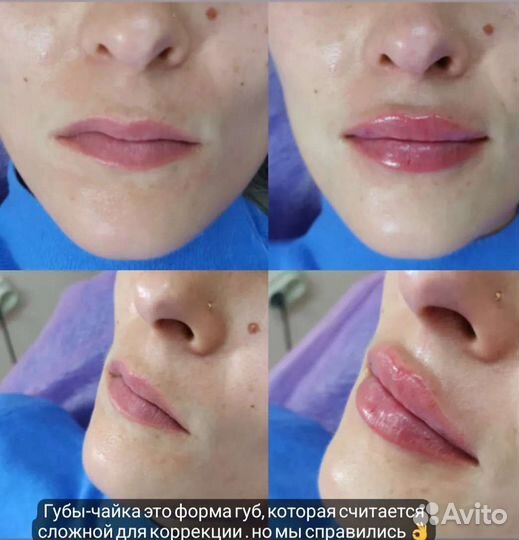 Модель на увеличение губ