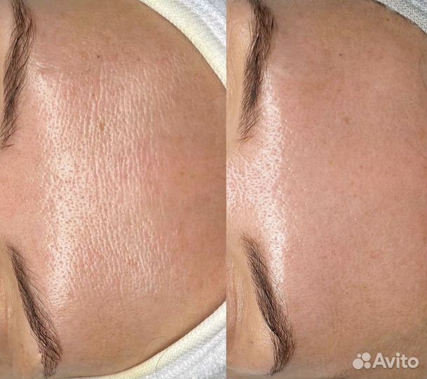 Карбокситерапия oily balance