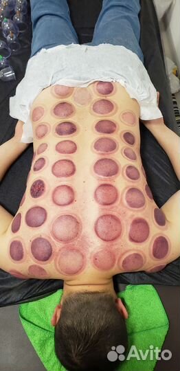 Массаж банками