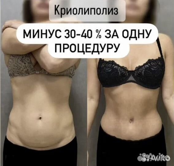 Криолиполиз