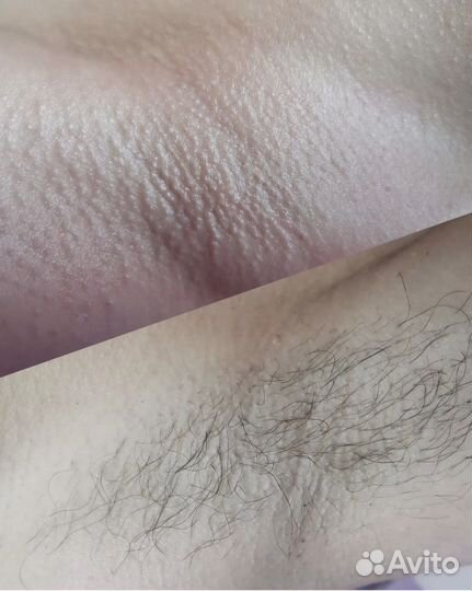 Обучение шугаринг,депиляция