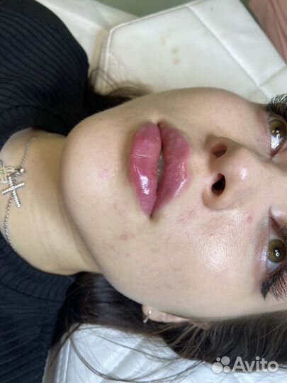 Увеличение губ