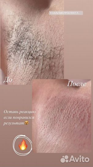 Шугаринг эпиляция