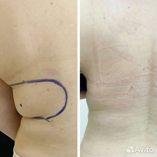 Криолиполиз