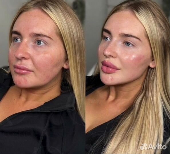 Косметолог: Лицо под ключ, филлеры