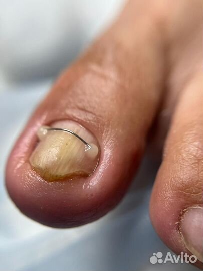 Установка титановой нити