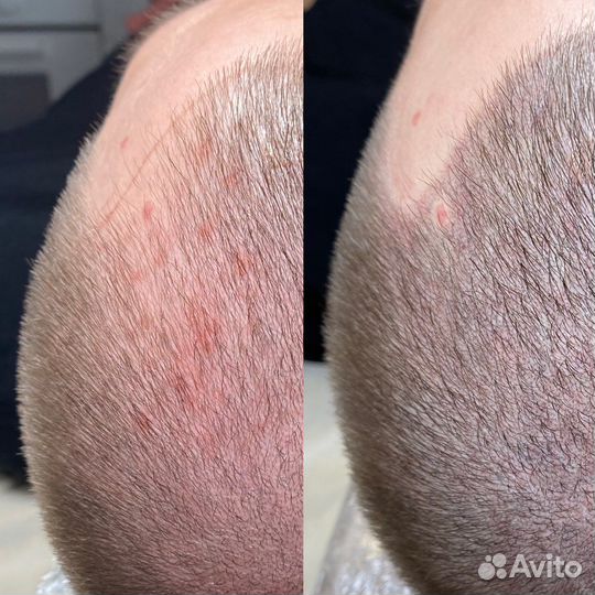 Трихопигментация для мужчин и женщин