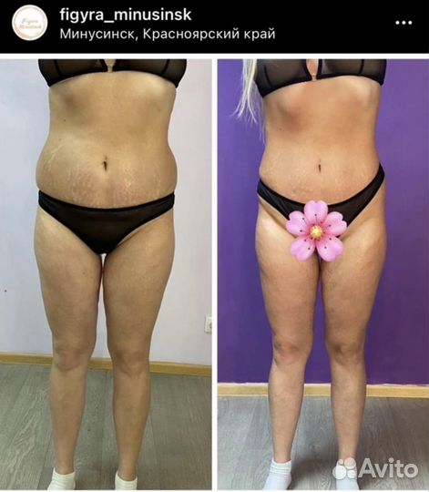 Кавитация, вакуумный массаж