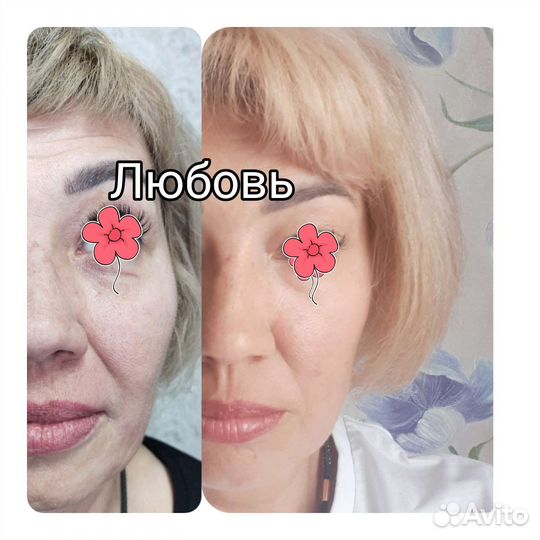 Криолиполиз,смас лифтинг