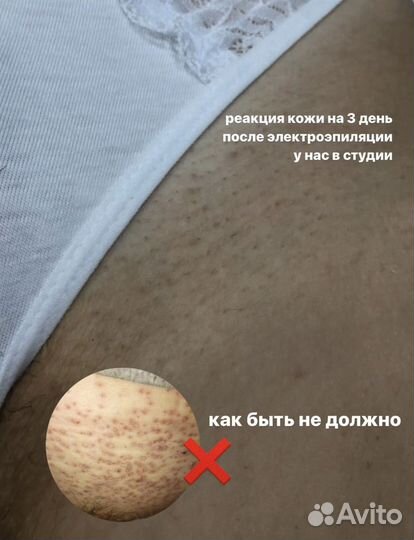 Электроэпиляция