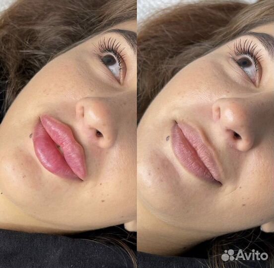 Модель на увеличение губ ботокс липолитик нити