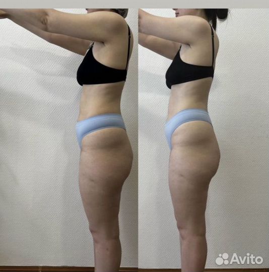 Мадеротерапия