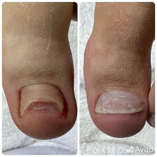 Подология лечение ногтей