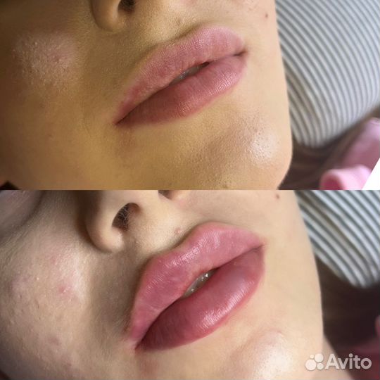 Биоревитализация