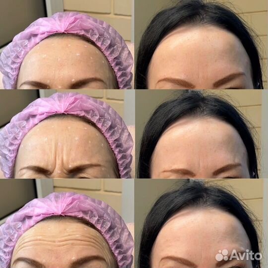 Ботокс для лица / Косметолог