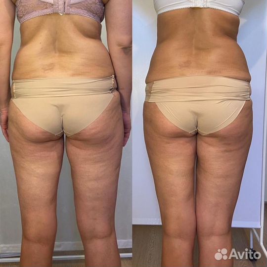 Аппаратный массаж (lpg,vela shape,субдермальный)