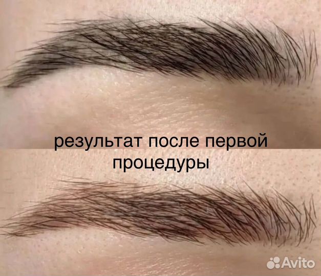 Лазерное удаление татуажа и тату в Москве