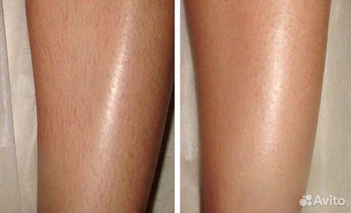 Шугаринг: руки выше локтя