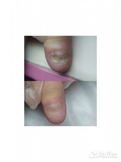 Подолог проблемный педикюр протезирование скоба