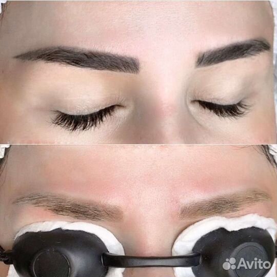 Удаление татуажа