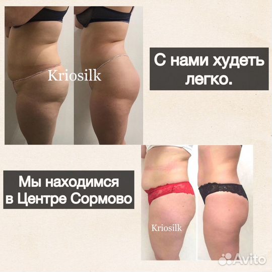 Криолиполиз