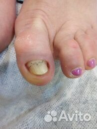 Медицинский педикюр, подолог