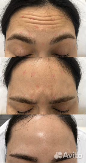 Ботулинотерапия