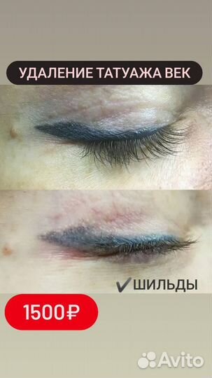 Удаление татуажа бровей лазером