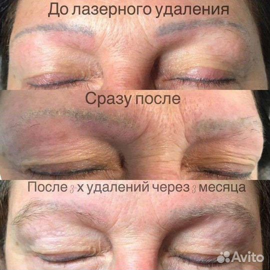 Удаление старого татуажа или тату