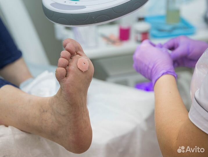 Удаление бородавок