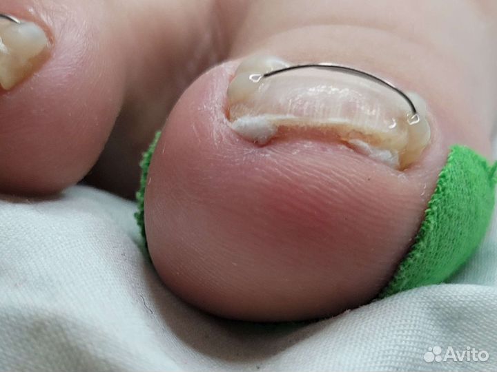 Установка титановой нити